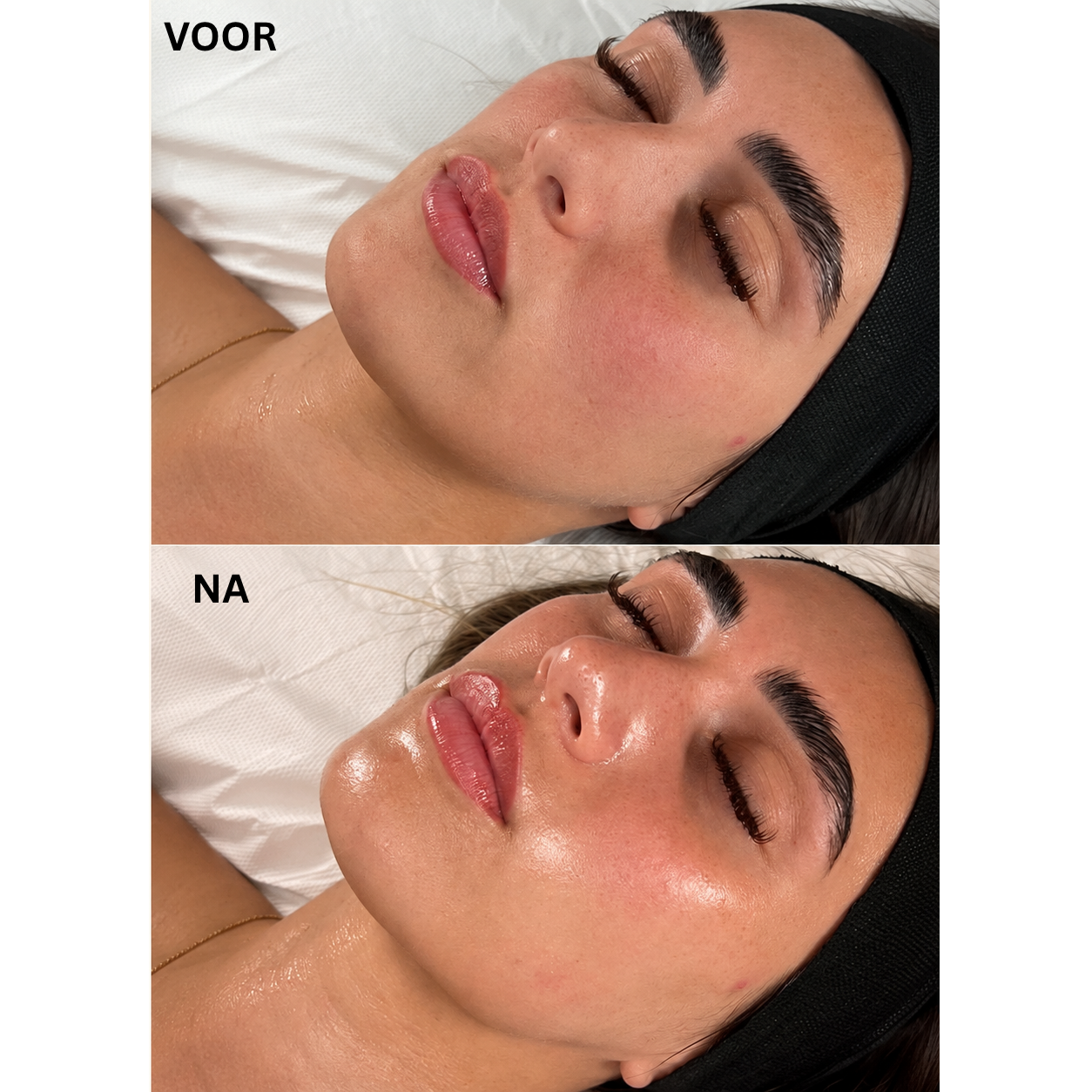 Huid voor de behandeling